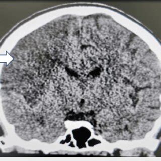 Contrast Enhanced MRI Of Left Ankle Joint In Case 1 Demonstrated