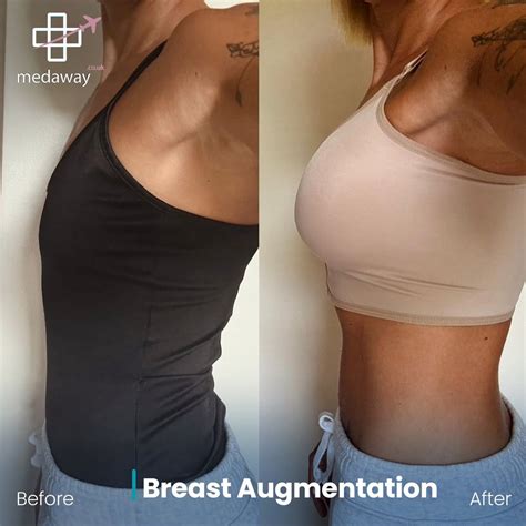 Boob Job Before And After Up To OFF Packages MedAway
