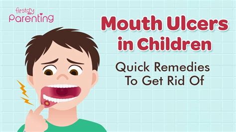 How To Remove Canker Sores On Lips