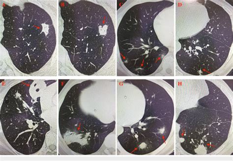 Chest Ct Of The Patients A Nodule With Spicule Sign In The Left Upper Download Scientific