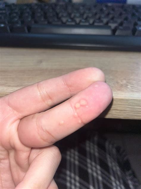 Break out of warts, never had warts before this cluster formed some