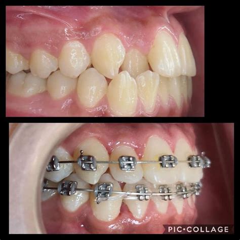 Brackets Cer Micos O Met Licos Cual Debo Escoger Cl Nica Nudent