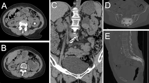 Transitional Cell Cancer With Sclerotic Bone Metastases