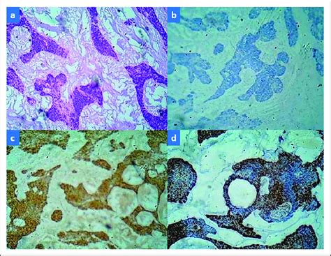 A Histopathology Suggested Mixed Adenoid Cystic Carcinoma With Both Download Scientific