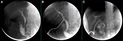 Illustration Of Postoperative Cholangiography Figure A Illustrates