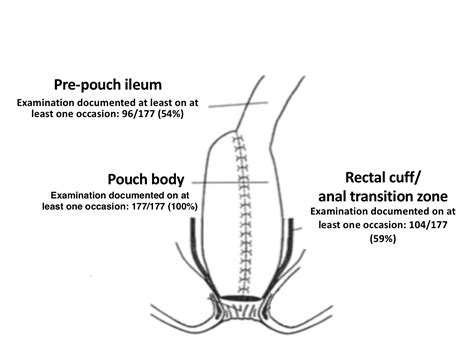 Current Practices In Ileal Pouch Surveillance For Patients With