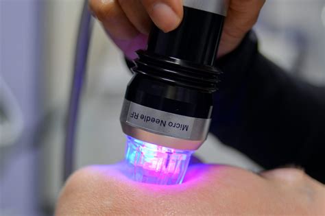 rf needling dermal medik clinic gold coast