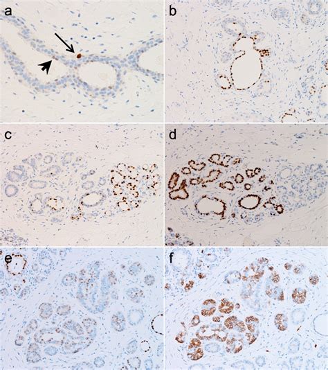 Pathological Features Of Pou F Positive Cells In The Human