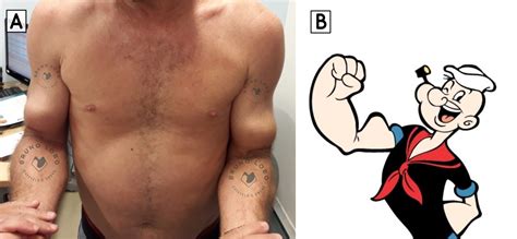lesoes da cabeca longa  biceps bruno lobo