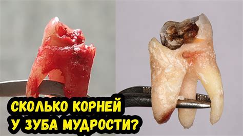 Как выглядит зуб мудрости, фото, видео / (Выпуск 10) - YouTube