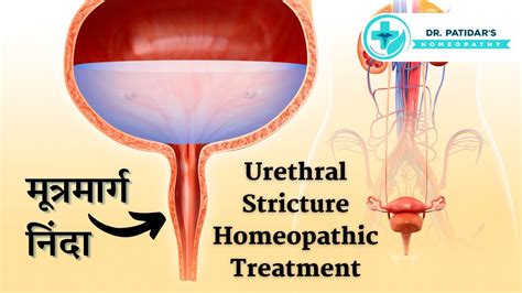 Urethral Stricture Homeopathic Treatment Symptoms Causes