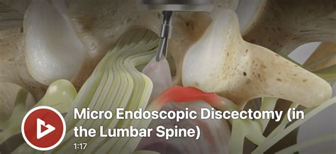 Minimally Invasive Microendoscopic Discectomy Procedure Disc