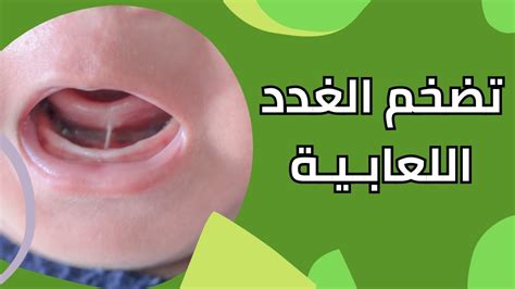 ما خطورة تضخم الغدد اللعابية والليمفاوية عند الأطفال؟ طبيب يوضح Youtube