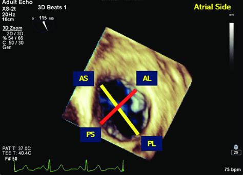 Three Dimensional View Of Tricuspid Annulus From Atrial Side Yellow