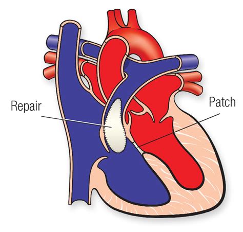 Tetralogy Of Fallot American Heart Association