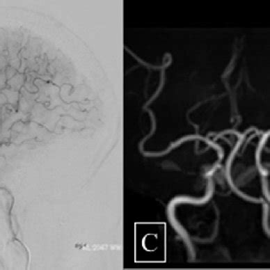 Right Common Carotid Angiograms A Anteroposterior View B Lateral