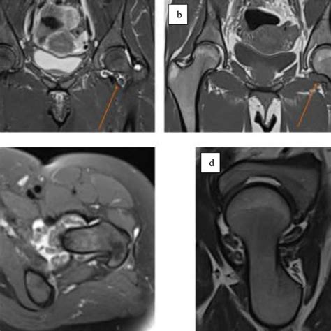 [PDF] Pigmented villonodular synovitis of the hip joint: Three cases demonstrating ...