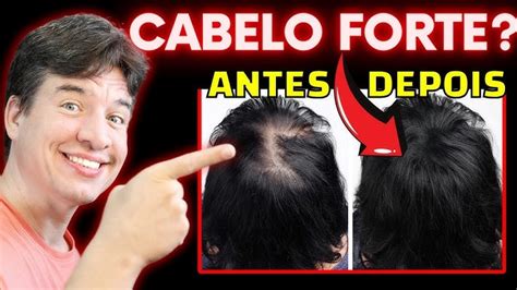 Fio De Cabelo Grosso E Irregular - Fio De Cabelo Mais Grosso Do Mundo Queda De Cabelo Afeta 1 Em 4 Após