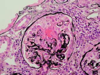 Photomicrograph Of A Renal Biopsy From A Patient With Active