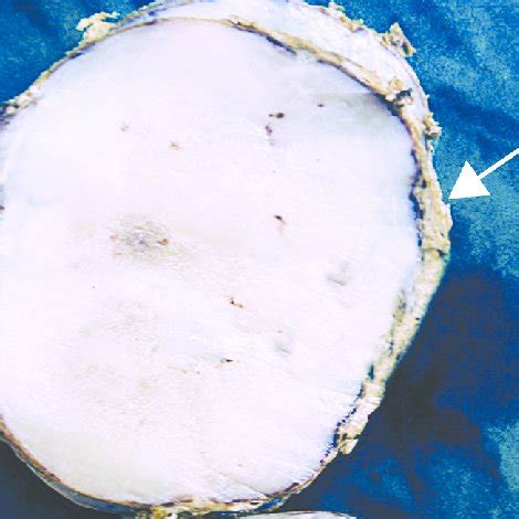 Gross Appearance Of IMT The Tumor Is Circumscribed White Tan In Color