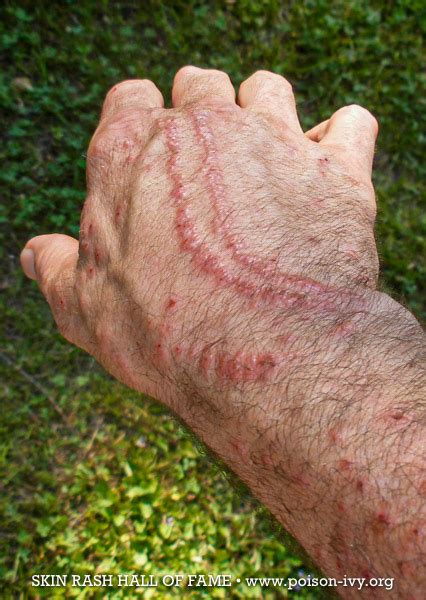 Poison Sumac Rash On Hands