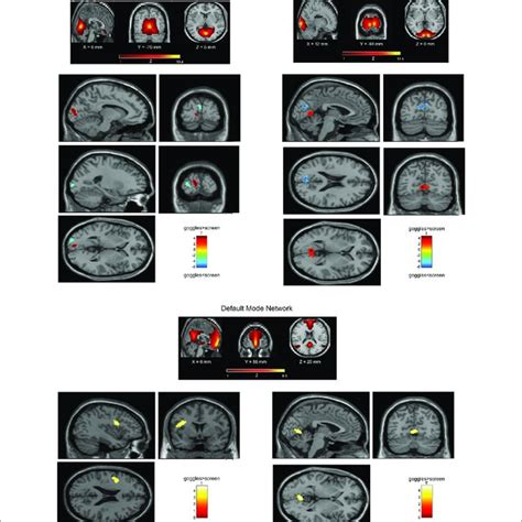 Network Spatial Maps And Group Differences Default Mode Network Download Scientific Diagram