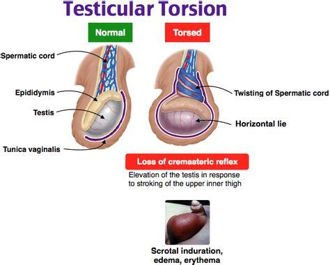 How To Diagnose Testicular Torsion