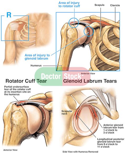 Shoulder Injury Torn Glenoid Labrum And Rotator Cuff Tendon Tears