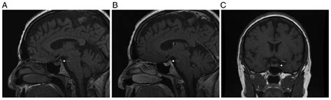 Mri Of Our Patients Pituitary Gland A Non Contrast T1 Sagittal