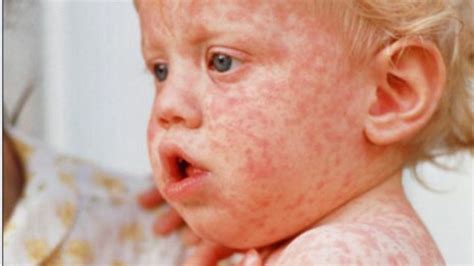 Measles Outbreak Australia 2024 Rycca Rosamond