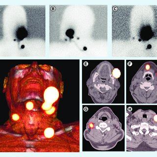 Mobile-camera detection of the sentinel lymph node(s) during sentinel ...