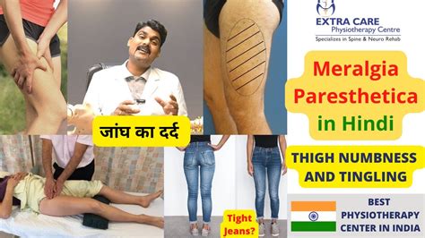 MERALGIA PARESTHETICA IN HINDI जघ क दरद Thigh Numbness Burning