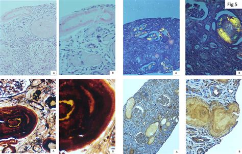 Diagnosis Of Amyloidosis Clinicopathological Advances And Challenges