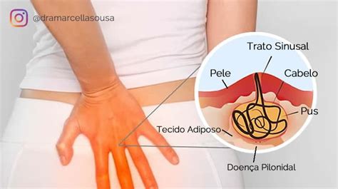 O Que Doen A Pilonidal Ou Cisto Pilonidal Dra Marcella