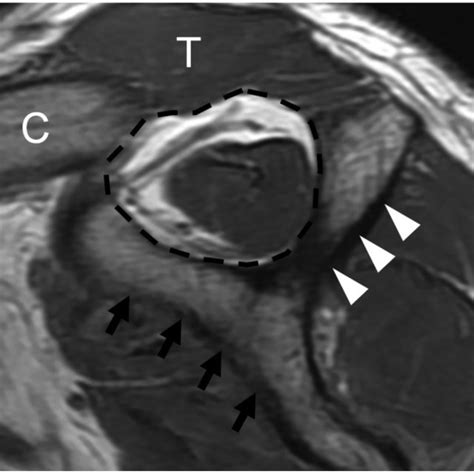 MRI assessment of supraspinatus muscle volume. Supraspinatus atrophy ...