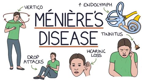 Understanding Meniere’s Disease Ask The Nurse Expert