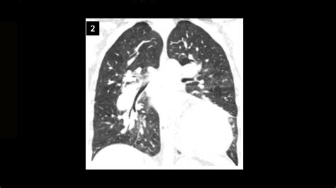 Unrepaired Persistent Truncus Arteriosus In An Adult Siemens Healthineers