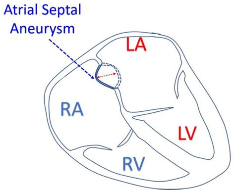 Atrial Septal Aneurysm – All About Cardiovascular System and Disorders