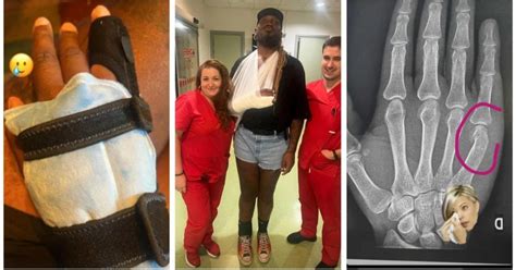 Francuski DJ tvrdi da je brutalno napadnut u Tisnom slomljena mu je ruka Sve zato što sam gay