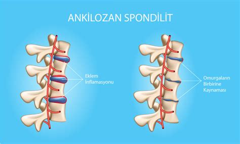 Ankilozan Spondilit Nedir Kimlerde Görülür MoovBuddy