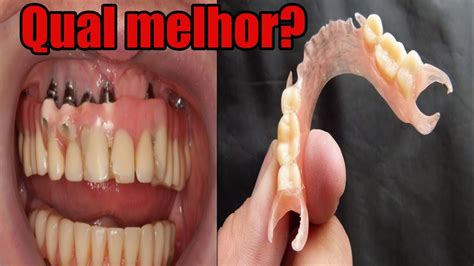 Implante Dentário x Prótese Parcial Removível PPR Qual melhor