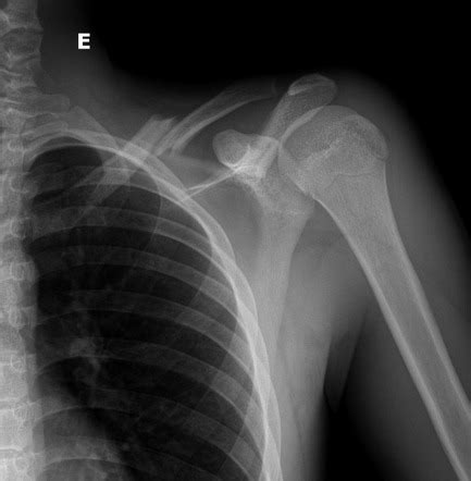 Clavicle Fracture Radiology Case Radiopaedia Org