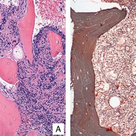 Morphologic Findings A Bone Marrow Biopsy Showing Hypercellular