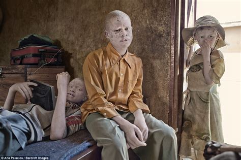 Rescue ‘fortress’ In Tanzania Protects Albinos From Human Hunters Daily Mail Online