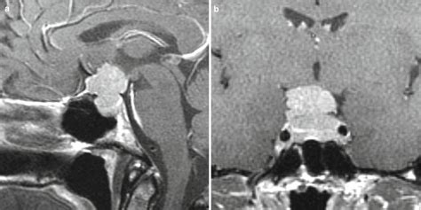 Meningioma Of The Sellar And Parasellar Region Neupsy Key