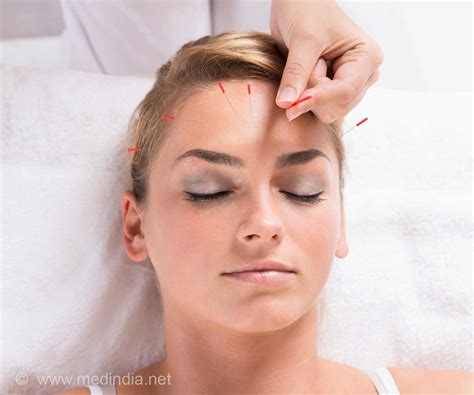 Acupuncture Benefits Bells Palsy Patients