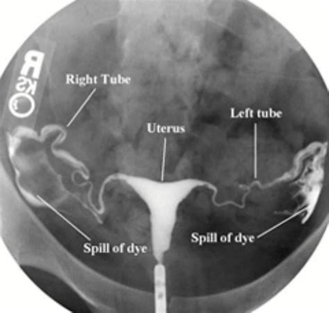 Ahysterosalpingogram Hsg Radiology Students Of Ams
