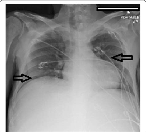 Chest X Ray Showing Trace Bilateral Pleural Effusions And Ill Defined