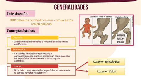 Luxacion Y Displasia De Cadera Ppt Pdf Unjfsc Ppt