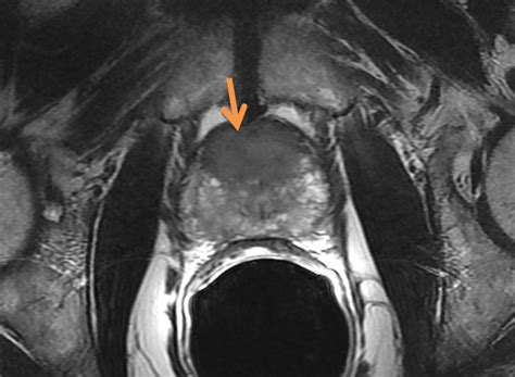 MRI Improves Detection of Higher Risk Prostate Cancer - Renal and ...